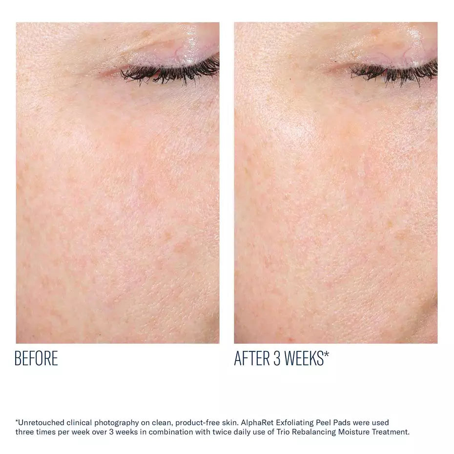 Alpharet Exfoliating Peel Pads