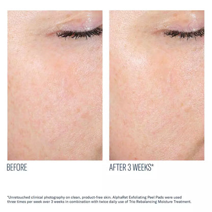 Alpharet Exfoliating Peel Pads
